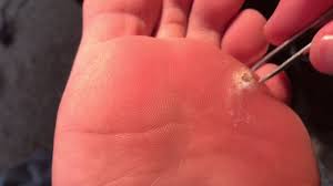 Maybe you would like to learn more about one of these? Day 53 Plantar Wart Removal Update Digging Out The Middle Again Youtube