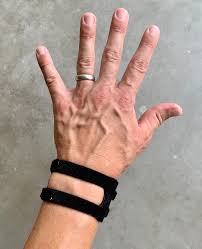 Image result for TFCC Steroid Injection