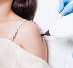 Tattoo removal with laser Munich | PlexR®