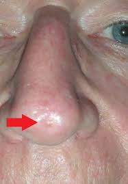 Fluorouracil topical has an average rating of 7.5 out of 10 from a total of 30 ratings for the treatment of skin cancer. Skin Cancer Nose With Local Flap Repair Dr Damian Marucci Cosmetic Plastic Reconstructive Surgeon