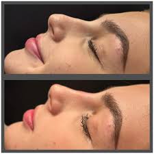 🇬🇧 The same-day result of the nose filler procedure I performed