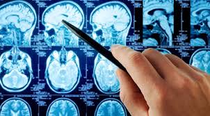 Bulanik Gorme Sorunu Tumor Habercisi Saglik Son Dakika Haberler
