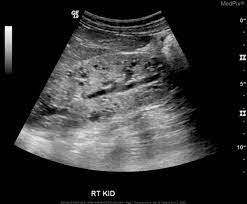 Autosomal Recessive Polycystic Kidney Disease Concise Medical Knowledge