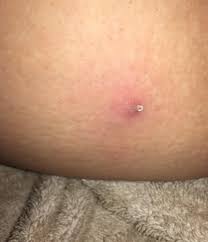 Tiny Pop From A Large Lump On My Inner Thigh Popping
