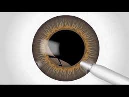 Could Cataract Dissolving Drops Replace Cataract Surgery Someday Cataract Surgery Cataract Cataract Surgery Recovery