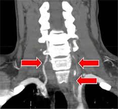 Ehlers Danlos Syndrome Presenting As Severe Headache In A Young Adult Sciencedirect