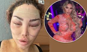 Jessica Alves says shes had 90 plastic surgeries in 20 years, unveilng  results of new procedure | Daily Mail Online