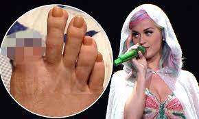 Katy Perry lawsuit from stagehand whose toe was amputated | Daily Mail  Online