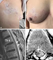 Image result for zoster under breasts