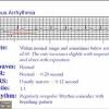 Emphasis on differentiating pericarditis and st elevation myocardial infarction (stemi). 1