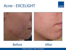 A treatment for severe nodular acne: Ipl Acne Treatment Rejuvenating Solutions