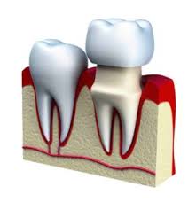 This generally occurs when the root of an infected tooth has gone many times with severe furcation, it might be too late for a root canal and the tooth would need to be extracted. I Had A Root Canal Why Do I Need A Porcelain Crown