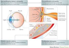 Jul 17, 2019 · the centers for disease control and prevention (cdc) maintains the national vision and eye health surveillance system (vehss). Diabetic Retinopathy Nature Reviews Disease Primers