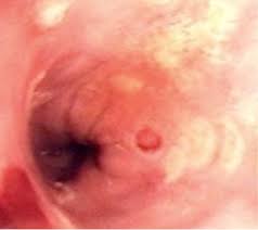 Esophagitis caused by cmv infection, most commonly occurring in patients with immunocompromise1,2,3. Herpes Simplex Virus Esophagitis In An Immunocompetent Patient Infectious Diseases