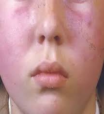 Image result for red rash face