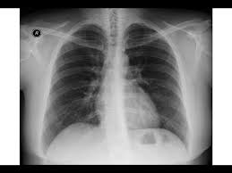Chest X Ray Interstitial Lung Disease Lung Fibrosis Traction Bronchiectasis Sarcoidosis Youtube