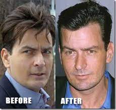 Demilovato Pictures Charlie Sheen Hair Transplant