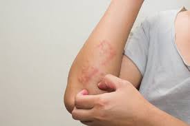림프절이 커지고 기침, 각혈(hemoptysis), 간 비대(hepatomegaly), 뼈가 시스템적인 증상: ê°„ê³¼ë˜ê¸° ì‰¬ìš´ ë°±í˜ˆë³' ì¦ìƒ 10ê°€ì§€ ê±´ê°•ì„ ìœ„í•œ ë°œê±¸ìŒ