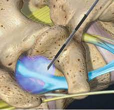 Inyeccion Epidural Lumbar Para El Tratamiento Del Dolor De Espalda
