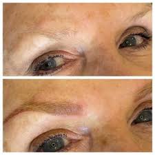 With tattoo vanish, there are fewer treatments needed and fewer costs, and it removes all colors and is less painful than when the tattoo was put on. Before After Gallery Of Cosmetic Tattoos Our Service