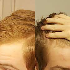 I M A 15 Year Old Guy And I Ve Been Noticing That My Hair Is Shedding More And I Think The Corners Of My Hairline Are Getting Thinner I My Hair Hairline