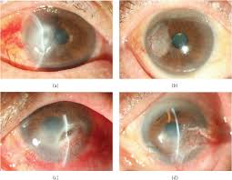 Any disease that can affect the clarity or refractive capability of the cornea in childhood can have devastating consequences as a result of refractive or deprivational amblyopia. Figure 1 From Conjunctival Flap Covering Combined With Antiviral And Steroid Therapy For Severe Herpes Simplex Virus Necrotizing Stromal Keratitis Semantic Scholar