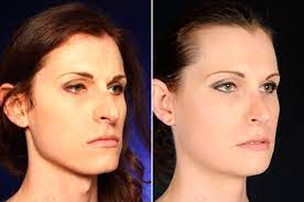 Адамово яблоко, кадык, ада́мово я́блоко, кады́к. Facial Feminization Surgery Tracheal Shave Reduzierung Des Adamsapfels 2pass Clinic