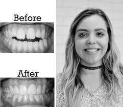 You've Been Burked: Sienna D