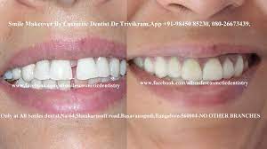 Pin By Dr Trivikram Cosmeticdentist B On Best Smile Makeovers In Bangalore Aesthetic Dentistry Smile Makeover Cosmetic Dentist