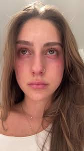 Soph Mosca Type 1 Diabetes