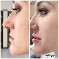 This week im giving you all a lip filler before and after ! Hyaluron Pen No Needle Lip Filler Lip Fillers Cosmetic Injectables Lips