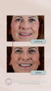 This lovely patient came to us hoping to improve her smile and expressed  concerns about the severe erosion (worn enamel)