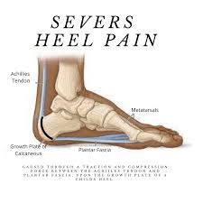 Image result for Calcaneal Apophysitis