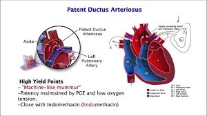 Image Result For Patent Ductus Arteriosus Ductus Arteriosus Patent Ductus Arteriosus Power Girl Fitness
