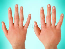 Pin On Rsd Crps Chronic Regional Sympathetic Complex Dystrophy