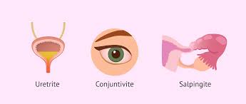 Image result for chlamydia symptoms