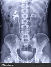 Image result for Intravenous Pyelogram