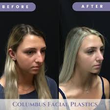 Rhinoplasty in Columbus, Ohio