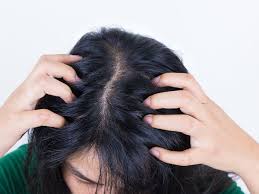 Sometimes an itchy scalp comes with normally itchiness is supposed to go away in a few days. Home Remedies For Dry Scalp Here S How Coconut Oil Probiotics Honey Can Give You A Healthy Hair Health Tips And News