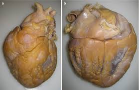 Image result for Pericardium
