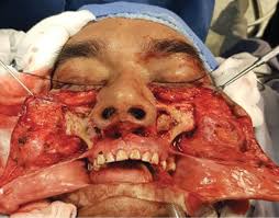 Mucormicosis rinocerebral en un niño diabético. Rhino Orbit Cerebral Mucormycosis With Palatal Manifestation In A Diabetic Patient Apropos Of A Clinical Case And Review Of The Literature