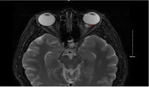 Image result for Optic Neuritis