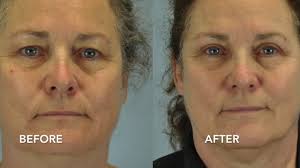 Protrusion, prolapse or elevation of the third eyelid, sometimes referred to as cherry eye, refers to the abnormal elevation of the smooth inner eyelid that is located between the cornea and the inside corner of the eyelids closest to the nose. Eyelid Surgery Dr Paul Vanek An Expert