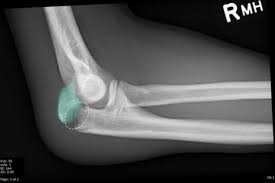 Image result for Radial Head Dislocation