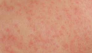 Natural Itch Relief Farmers Almanac Natural Itch Relief Itchy Skin Remedy Itch Relief