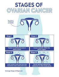 If there are any symptoms early on, they may include bloating, pelvic or abdominal pain, trouble eating, feeling full quickly, and urinary problems. What Is Ovarian Cancer Symptoms Causes Treatment Types