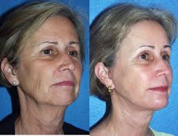 Stephen M. Krant, MD, FACS, Board Certified Plastic Surgeon