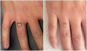 Yes, getting a finger tattoo is going to sting.skin lays right against the knuckle and bone, and your fingers are chock full of nerves. Real Skin Denmark 4x Picosure Finger Tattoos Takes Time To Remove