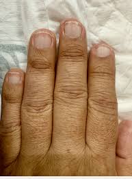 Terry's nails observed in a male patient diagnosed with ...