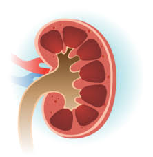 Kidney Stone Treatment Options John Wayne Cancer Institute